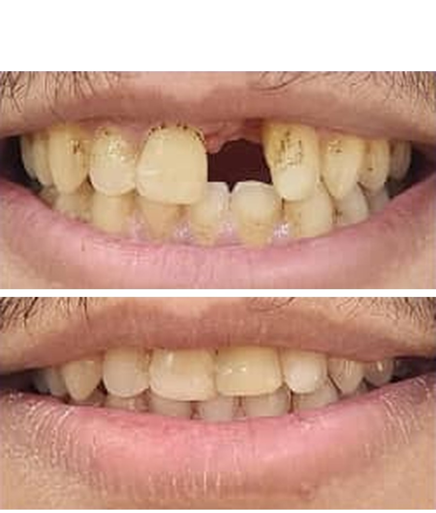 تصبغات — قبل / بعد
